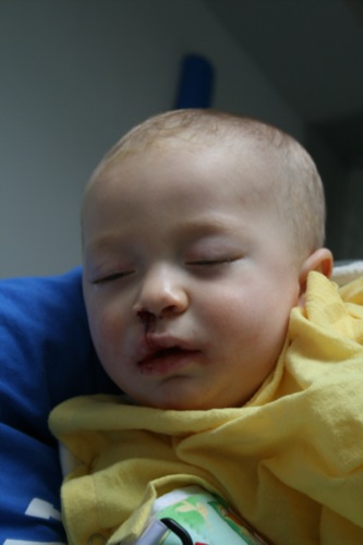 Mason just out of surgery